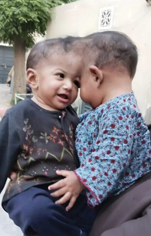Conjoined Twins with Fused Brain Structures Successfully Separated After 14-Hour Surgery. The Medical World is Stunned: See Them Now.