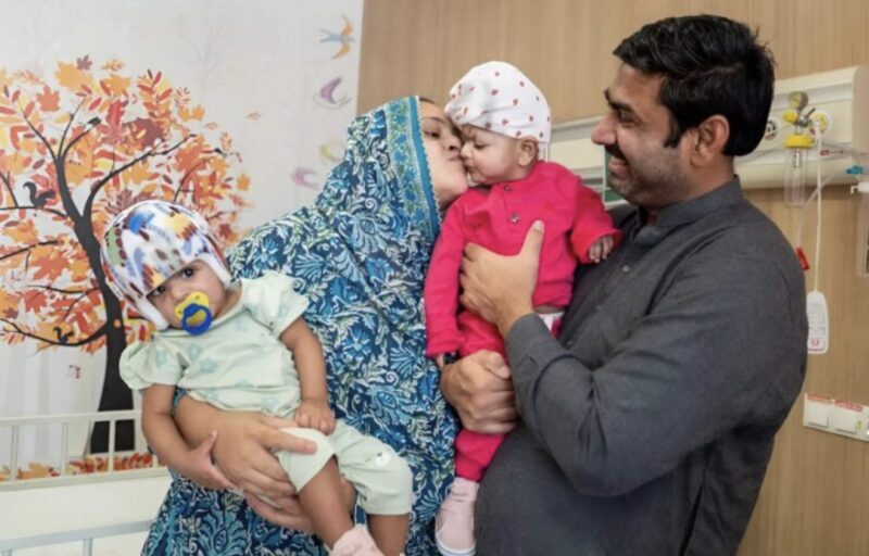 Conjoined Twins with Fused Brain Structures Successfully Separated After 14-Hour Surgery. The Medical World is Stunned: See Them Now.