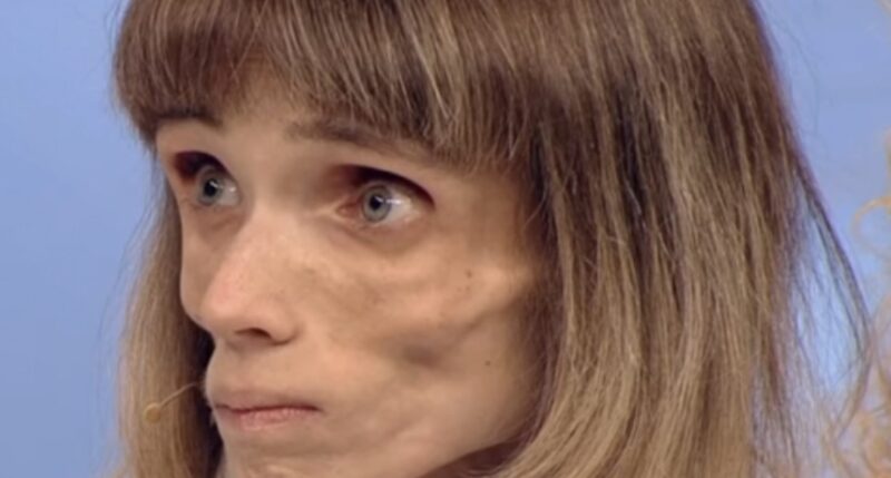 At 22, she weighed only 37 lbs (17 kg) and looked like an old woman